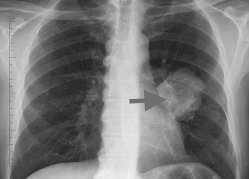 Туберкульоз на флюорографії / Фото: з вільних джерел