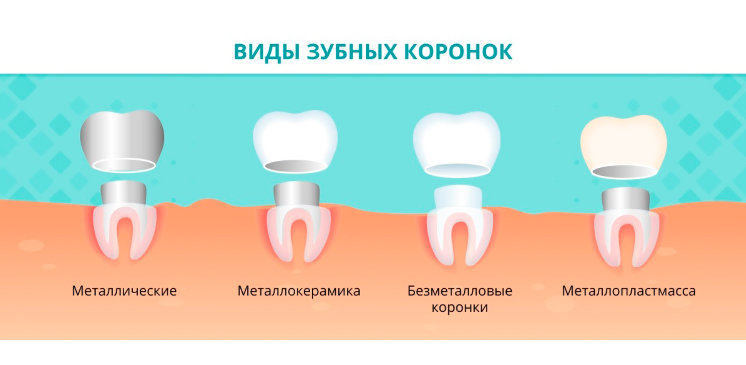 Со скольки лет можно ставить зуб. Коронка стоматология. Вкладка на зуб под коронку.