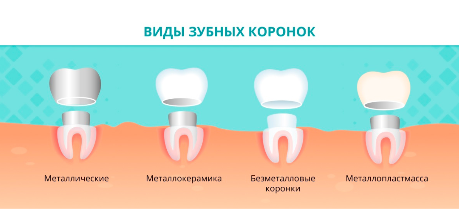 Чем отличаются зубные. Вкладка в зуб под коронку. Как ставят коронку на зуб. Как устанавливают коронку на зуб. Как ставится коронка на зуб.